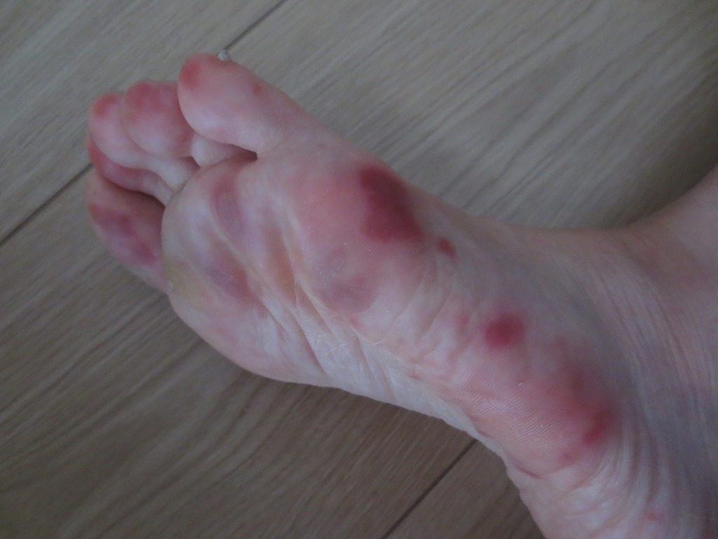 大人の手足口病は足の裏が一番痛い 男の子二人の育児ブログ